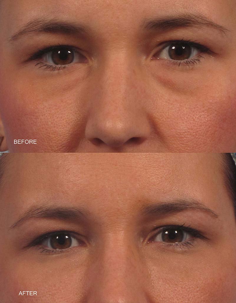 Under Eye Filler Dr Brett Kotlus