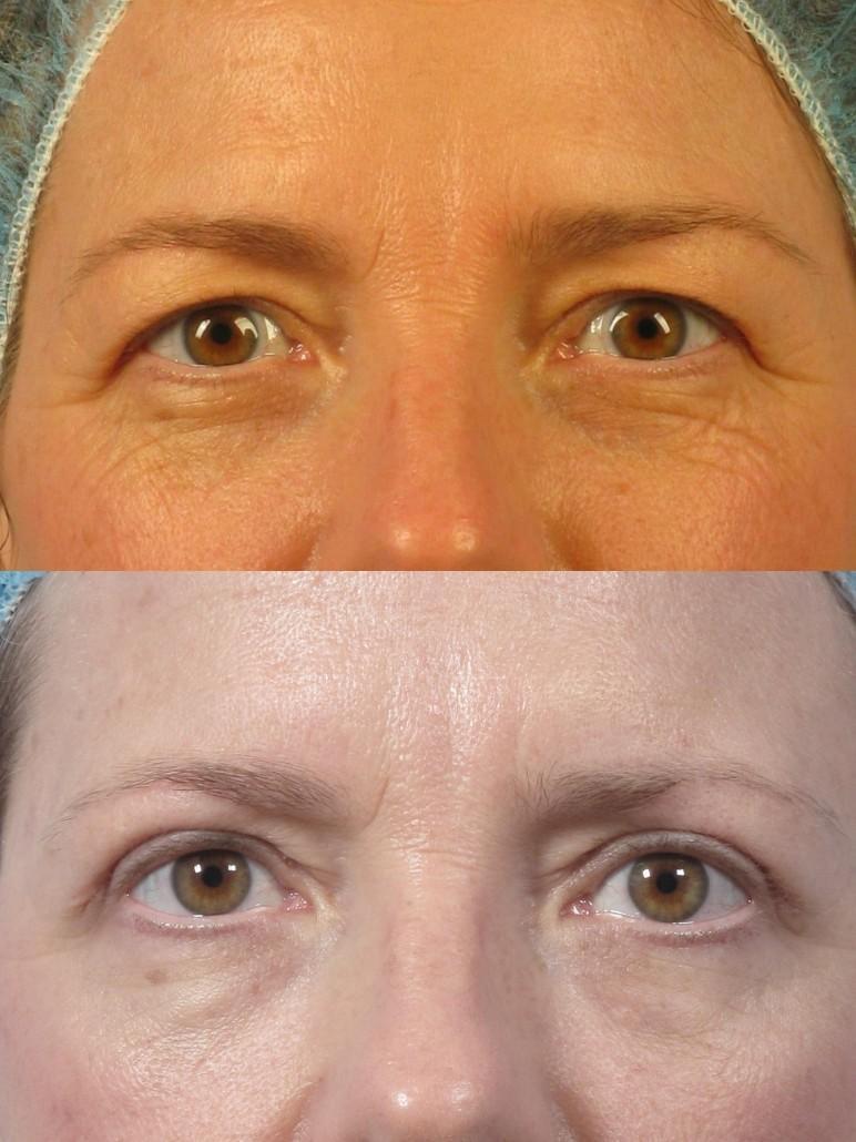 Cosmetic Oculoplastic Eyelid Lift Dr Brett Kotlus