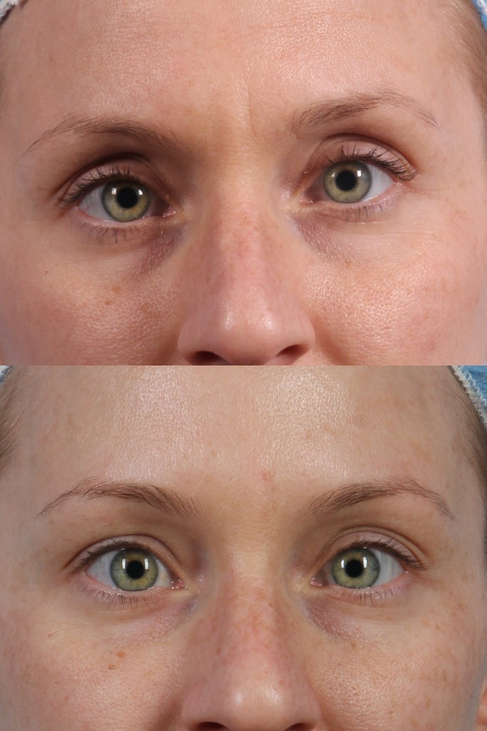 botox brow lift eyebrow eyebrows between before dysport nyc eyes brows injections york wrinkle surgical drkotlus non kotlus oculoplastic brett