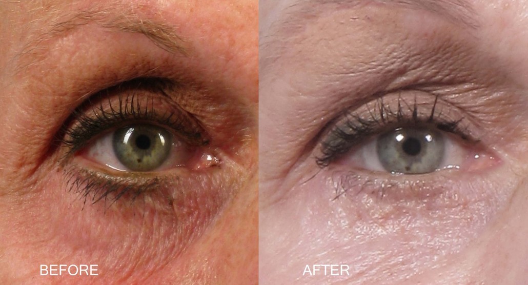 Dr. brett kotlus cosmetic oculoplastic canthopexy