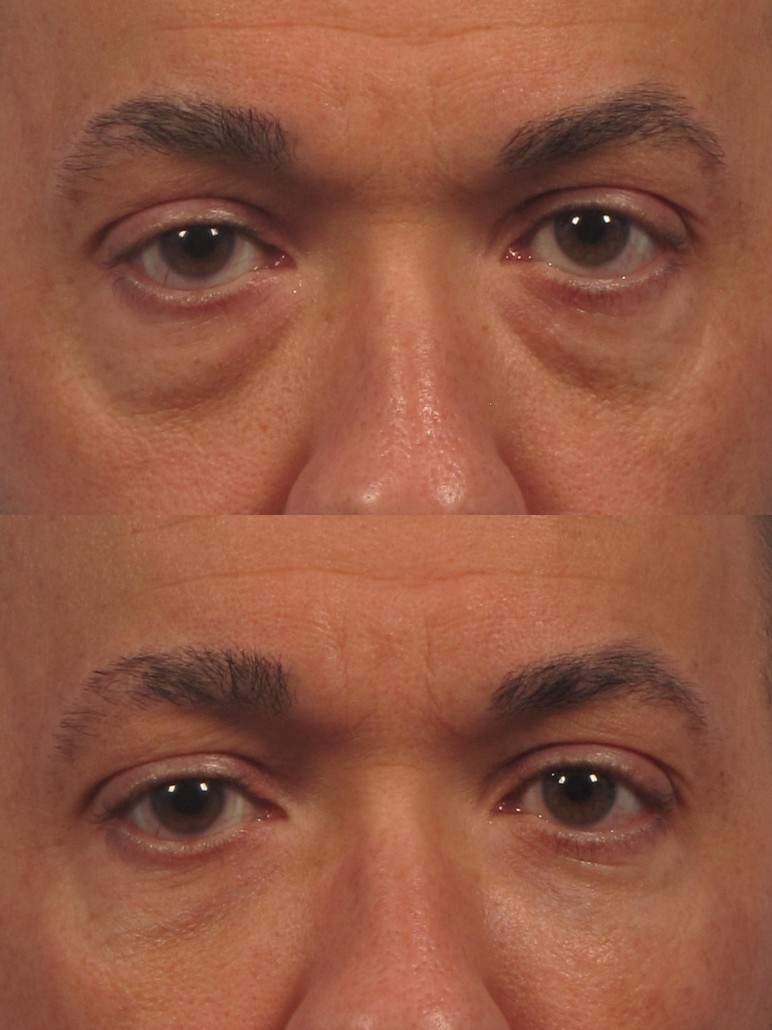 Cosmetic Oculoplastic Eyelid Lift Dr. Brett Kotlus, Cosmetic