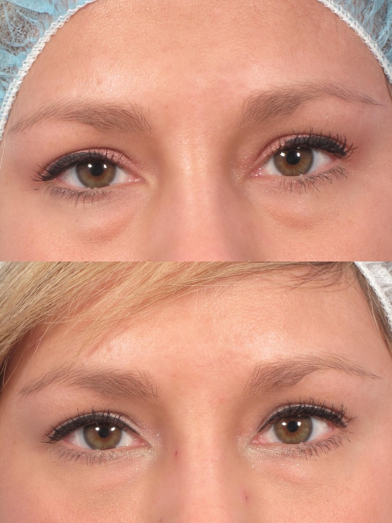 Under-eye bag removal - Vedas Medical Spa and Wellness Center