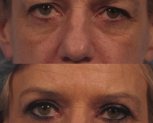 Dr. brett kotlus cosmetic oculoplastic blepharoplasty ny