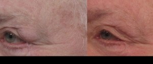 Dr. brett kotlus cosmetic oculoplastic lacrimal suspension
