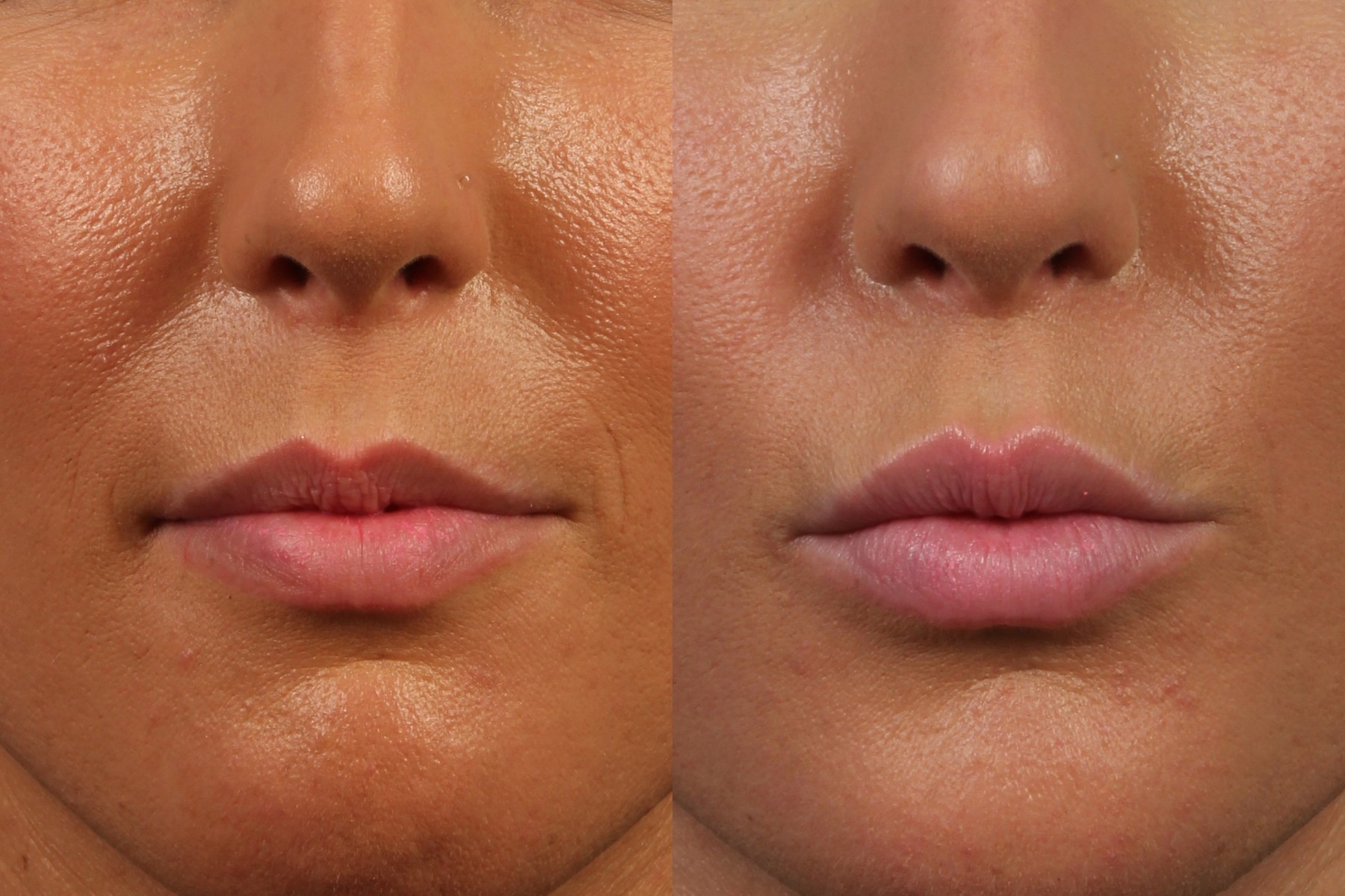 what-causes-white-bumps-on-lips-how-to-treat-it