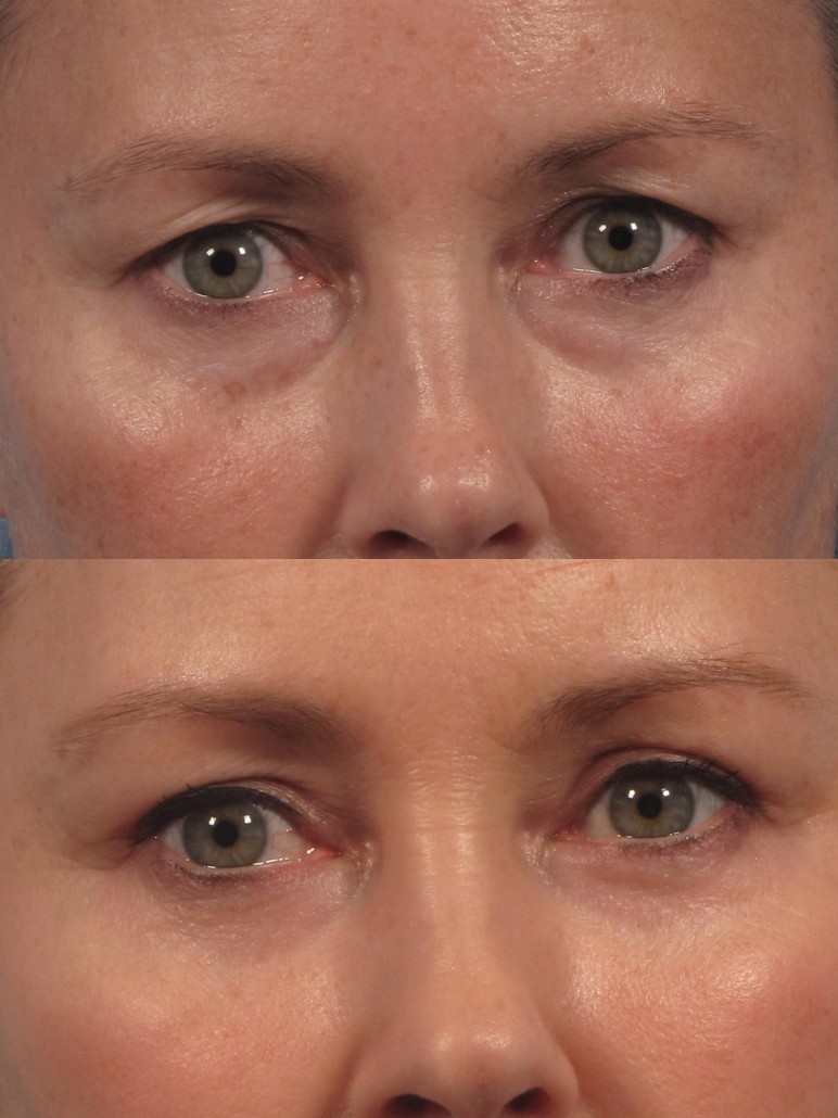 upper blepharoplasty gone wrong