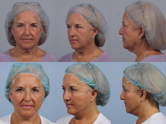 facelift revision nyc