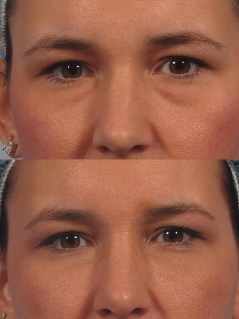 How to Reduce the Bags Under Your Eyes: Rostami OPC: Oculofacial