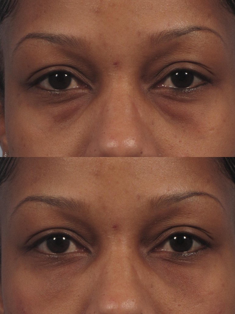 Dark Circles/Eye Bags | Dr. Brett Kotlus, Cosmetic Oculoplastic Surgeon