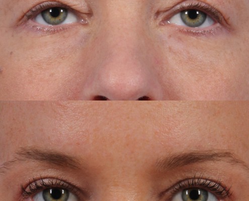 york treatment skin Oculoplastic Cosmetic Lift Dr. Brett Eyelid  Kotlus