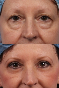 upper lower bleph nyc eye bags surgery ny