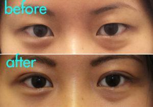 nyc double eyelid kotus asian blepharoplasty nyc