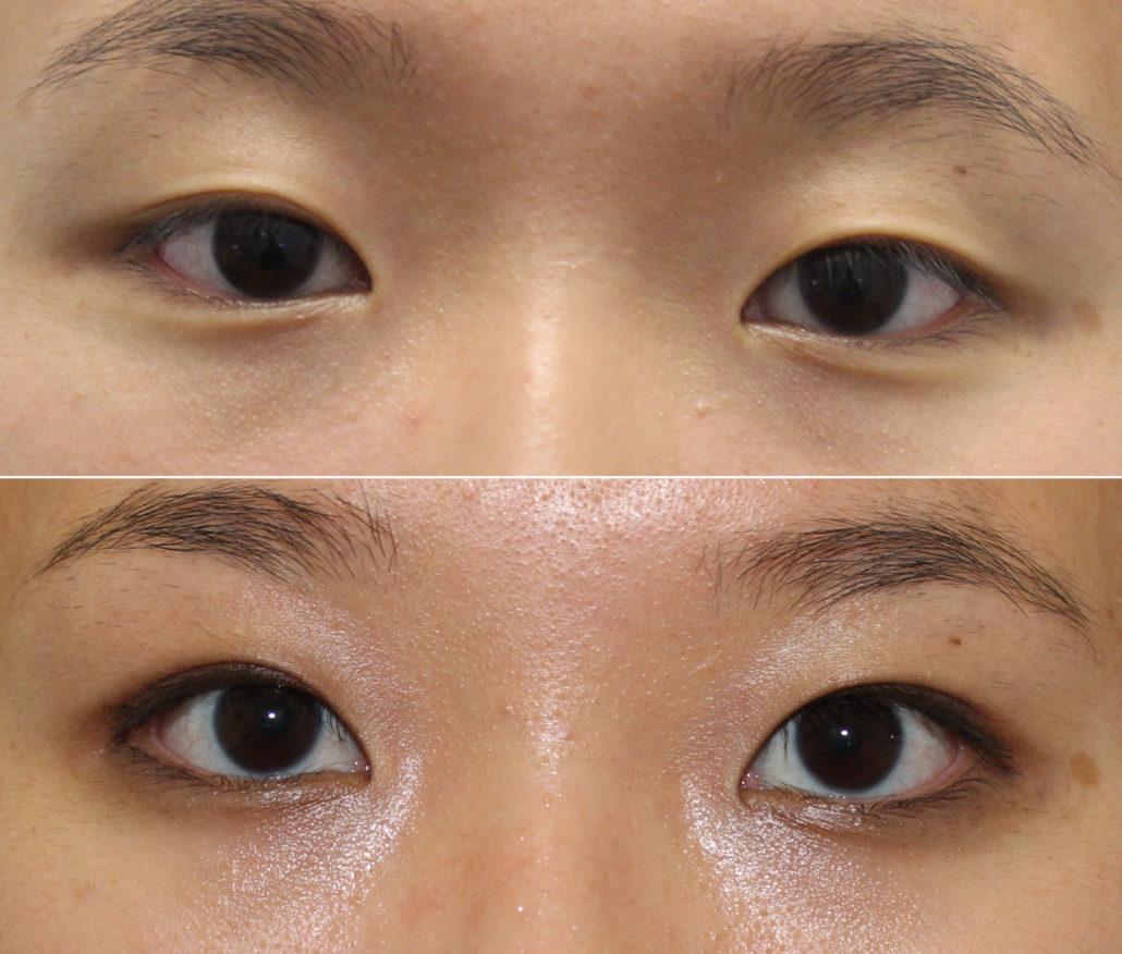 Asian Double Eyelid Photos - Dr. Brett Kotlus