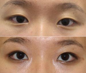 asian eyelid asymmetry dr. brett kotlus double eyelid surgery