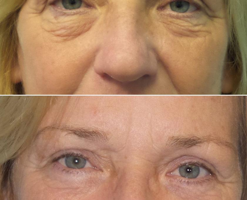 dr. brett kotlus lower blepharoplasty nyc