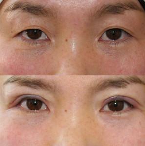 double eyelid suture method nyc dr. brett kotlus ny monolid surgery