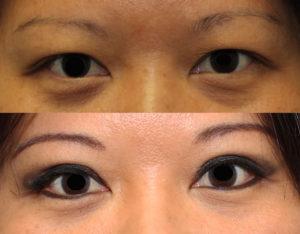 lid crease dr. brett kotlus asian double eyelid surgery