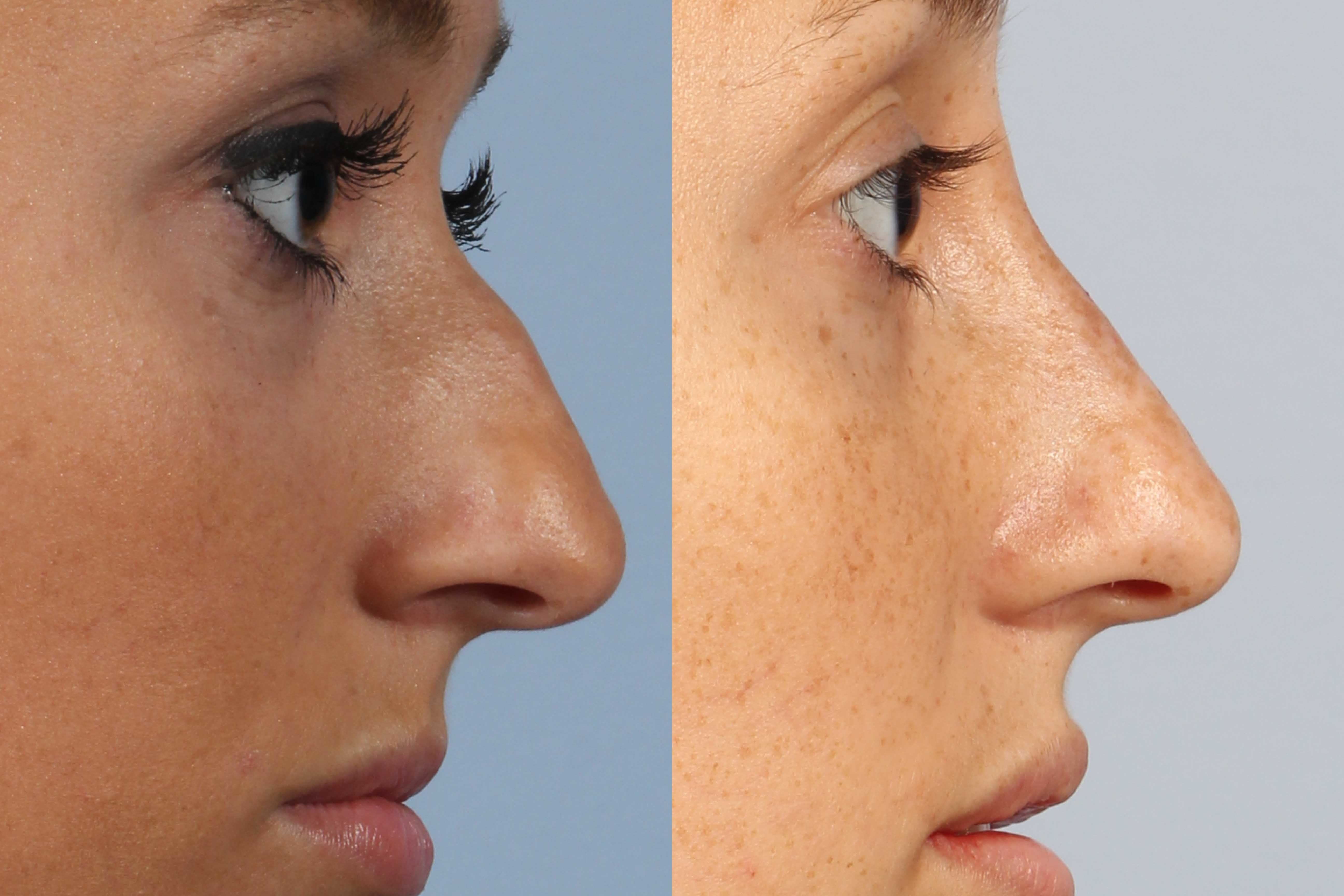 Fillers For Nose Before And After