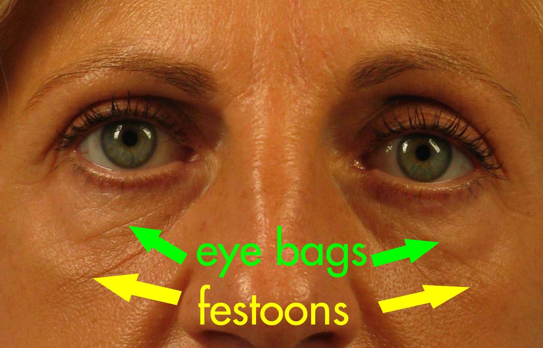 What Are Festoons? | Dr. Brett Kotlus, Cosmetic Oculoplastic Surgeon, NYC