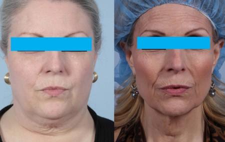 Why Does Weight Loss Make Your Face Look Older | Dr. Brett Kotlus ...