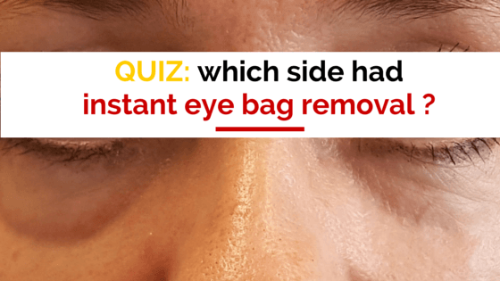 Eye Bags Can Disappear In Minutes Without Surgery Dr Brett Kotlus 