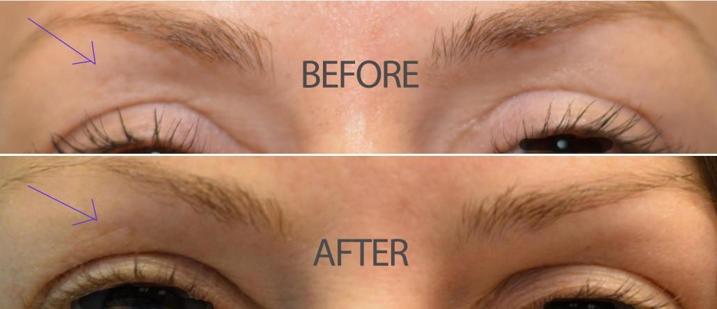 dr. brett kotlus upper eyelid filler