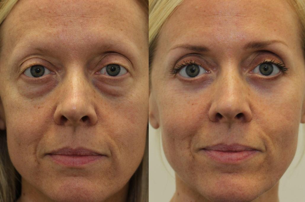 eye bag surgery