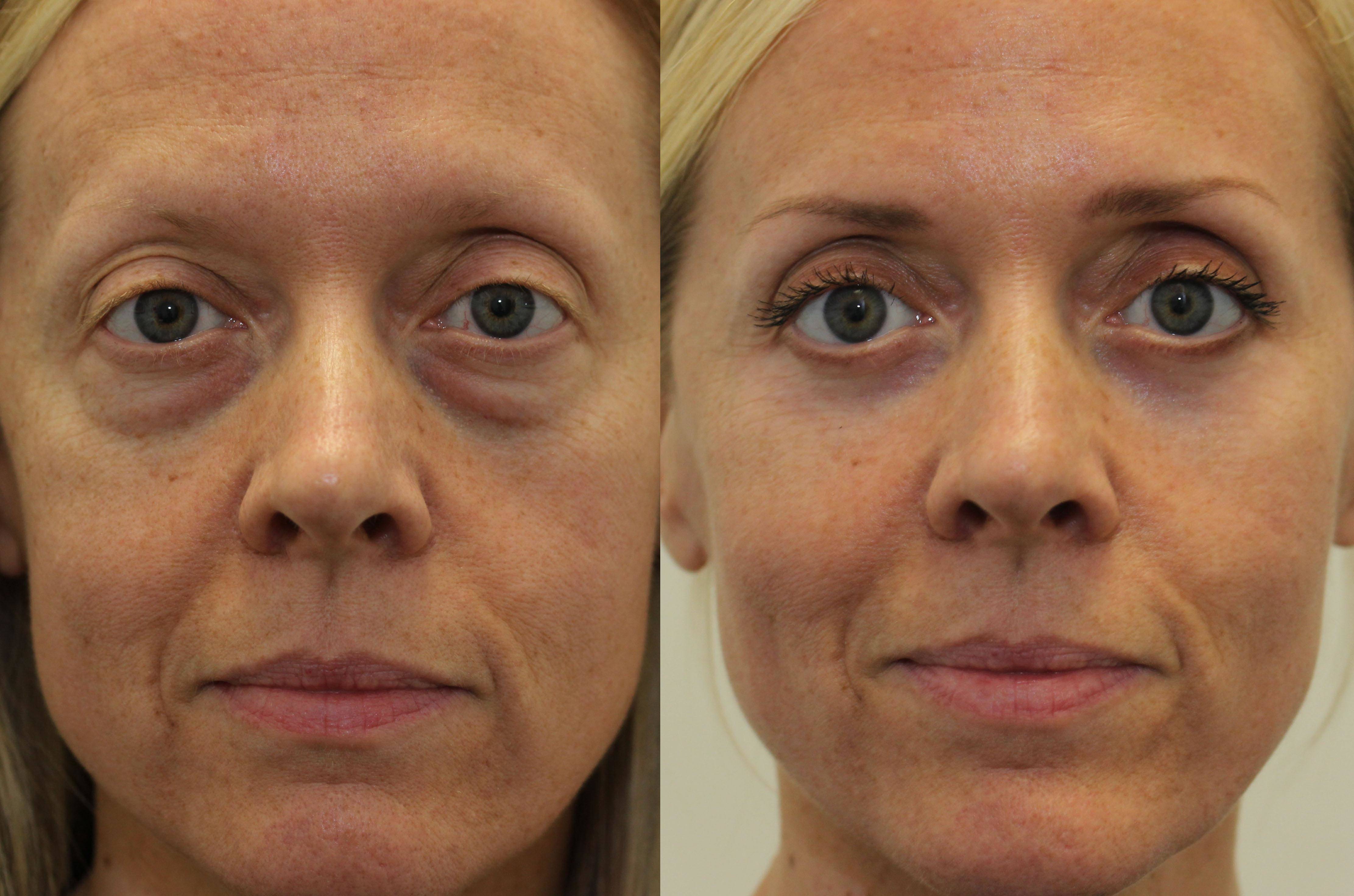 Lower Eyelid Lift (female) Dr. Brett Kotlus