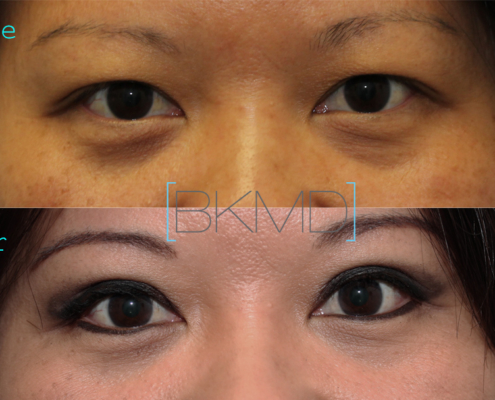 Primary Double Eyelid Surgery