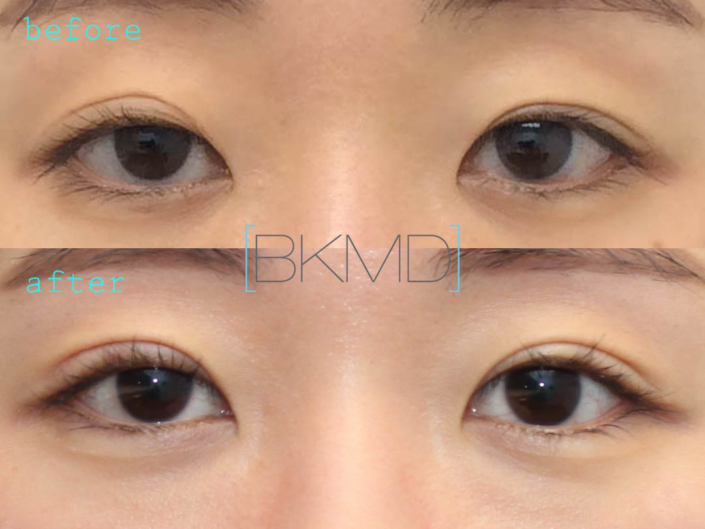 Revision Double Eyelid Ptosis Repair