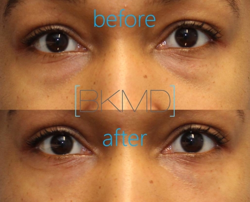 Cannula Eye Filler Treatment by Dr. Kotlus