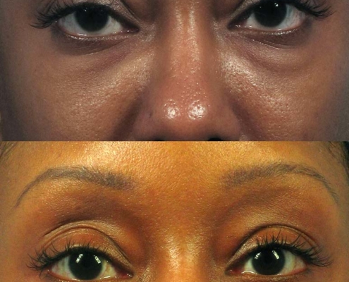 Cannula eye bag lift before and after