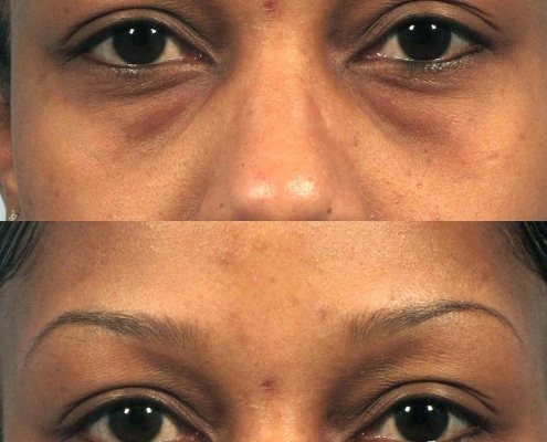 Under eye bag removal with Dr. Kotlus' Cannula filler treatment