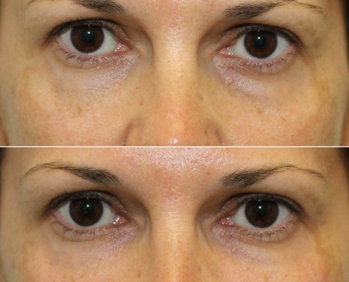 Dr. Kotlus undery-eye Cannula treatment remove years from your skin
