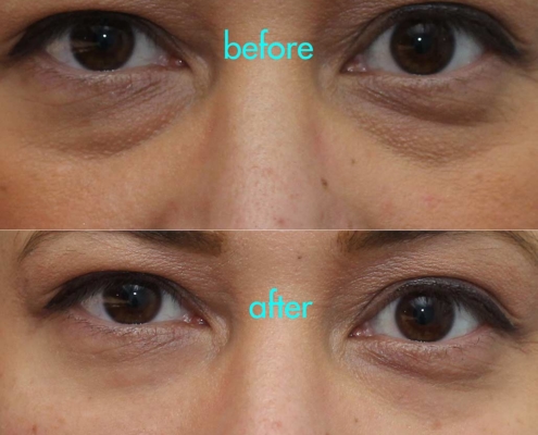 Get 5-10 Years off of your face with Dr. Kotlus' Cannula under-eye treatment