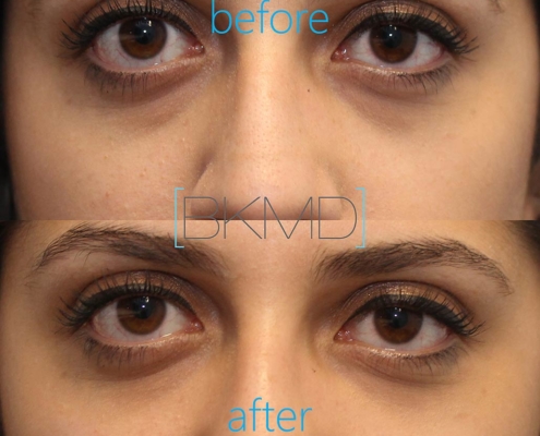 Dr. Kotlus Cannula Under Eye Treatment Before and After